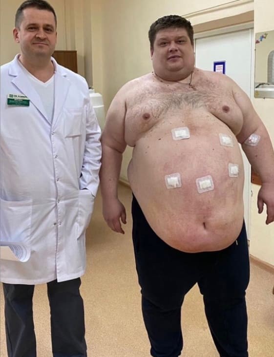 Бариатрическая операция — фотография пациента до операции