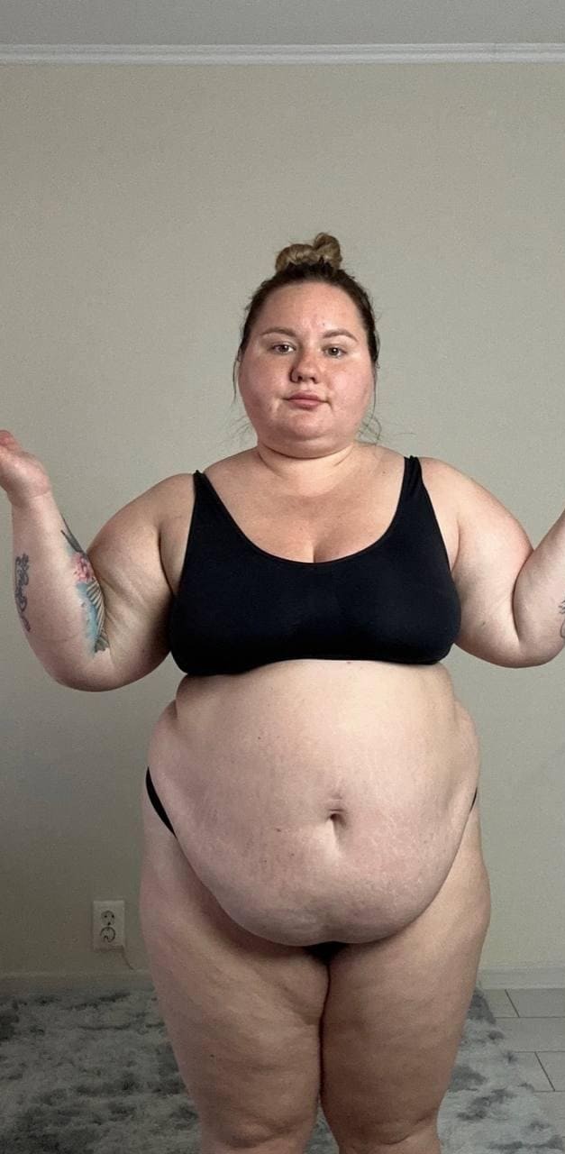 Бариатрическая операция — фотография пациента до операции